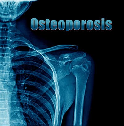 Osteoporosis